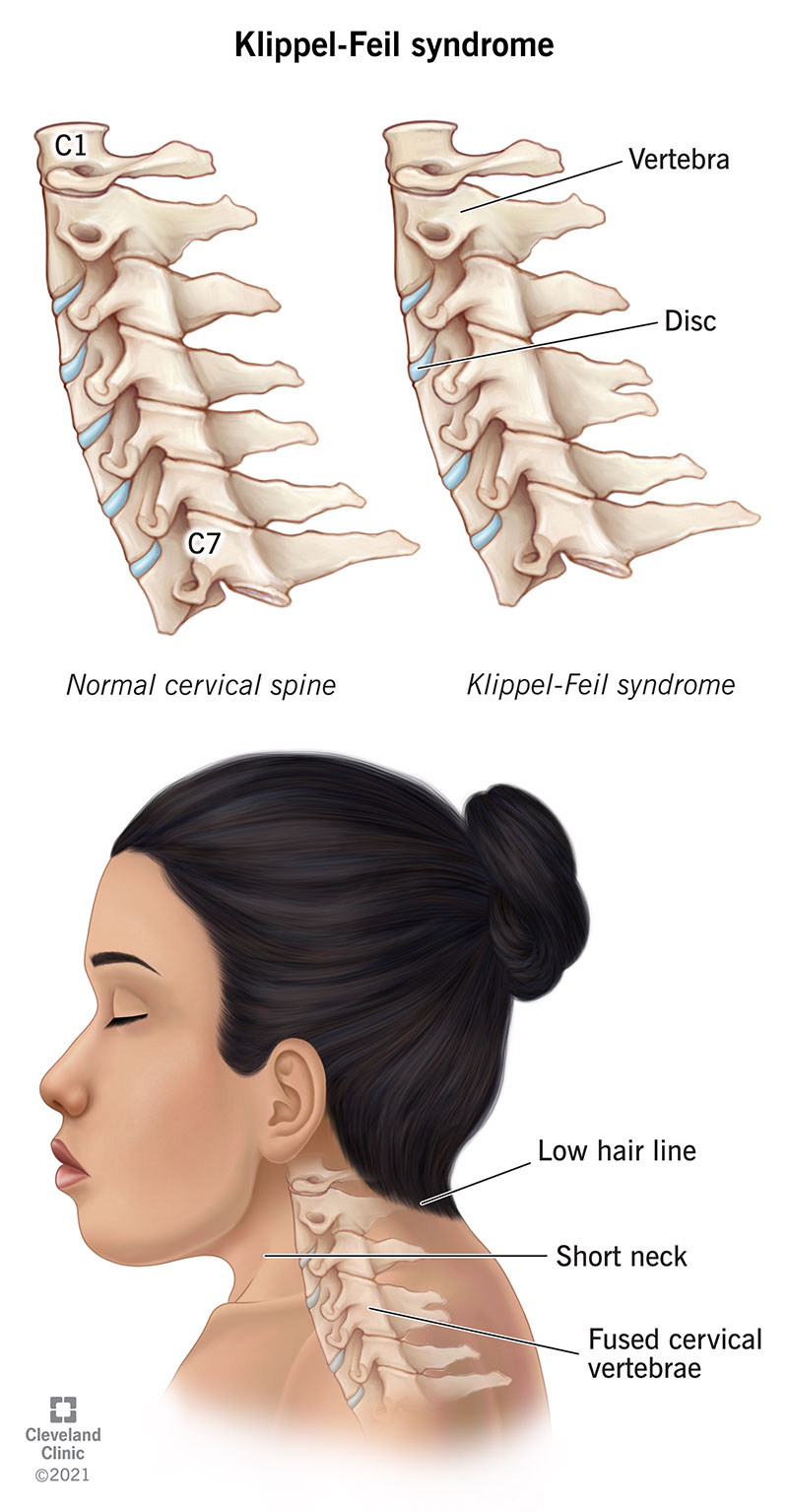 A woman with Klippel-Feil syndrome.